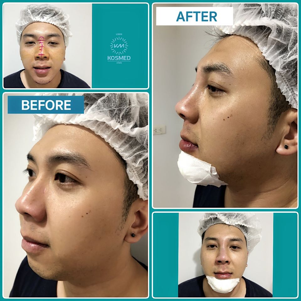 Review before-after immediately made nose augmentation, premium grade USA Standard Silicone